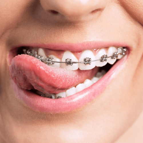 woman with metal braces in manchester after getting orthodontics treatment