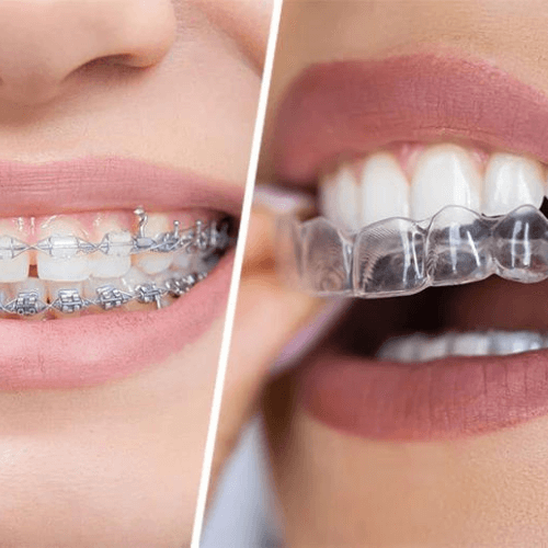 clear braces vs metal braces
