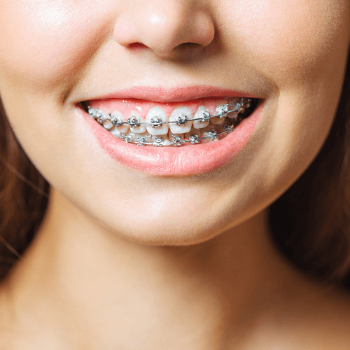 woman with braces in Manchester, orthodontics