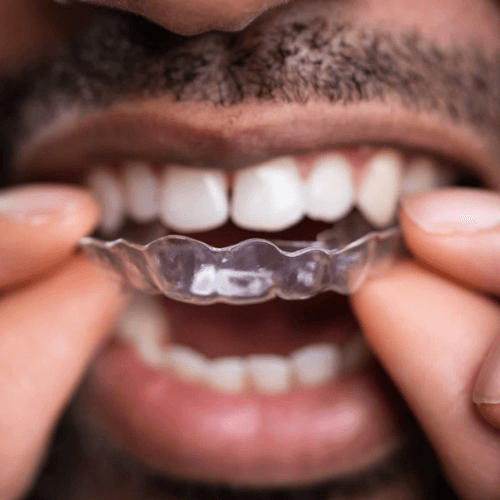 man holding invisalign aligners about to put them onto his teeth.