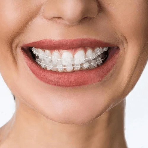 Woman smiling with clear braces, the six month smiles treatment in manchester.