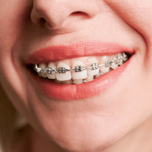 woman with Damon braces in Manchester smiling at the camera.