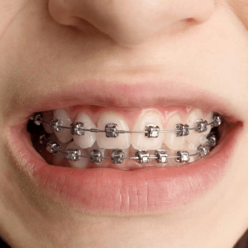 A male with damon braces on his teeth in Manchester