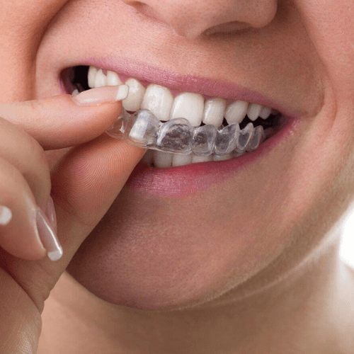 woman putting invisalign aligners on her teeth