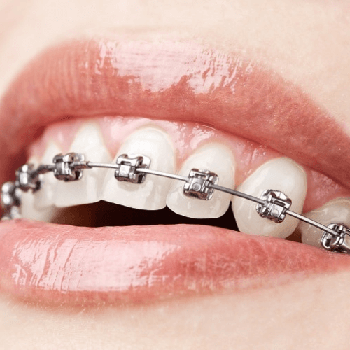 woman smiling with damon braces on her teeth