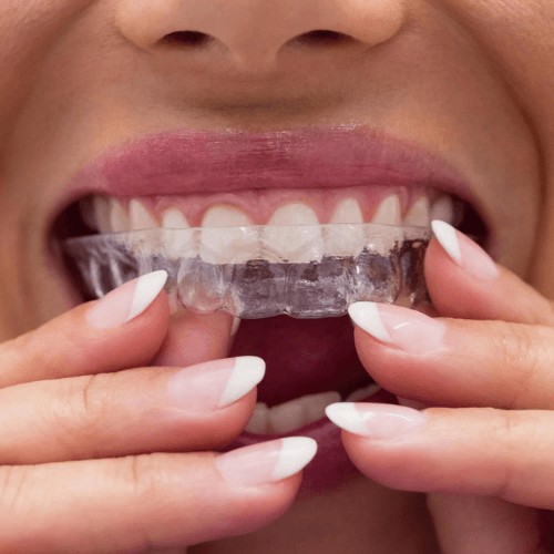 woman showing how invisalign aligners will fix bite issues