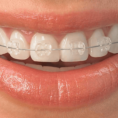 woman smiling with damon braces on her teeth.