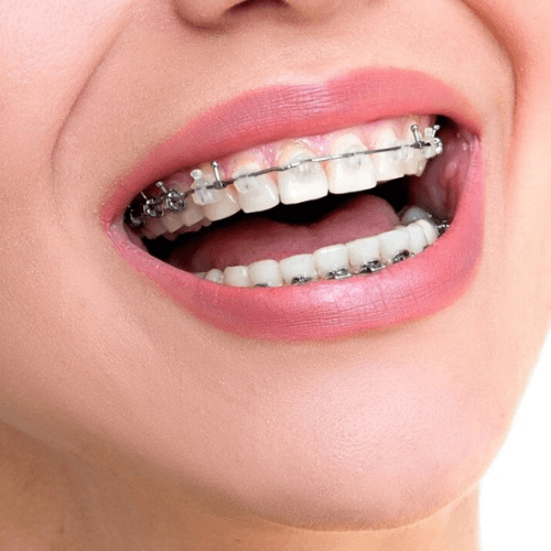woman smiling with damon braces