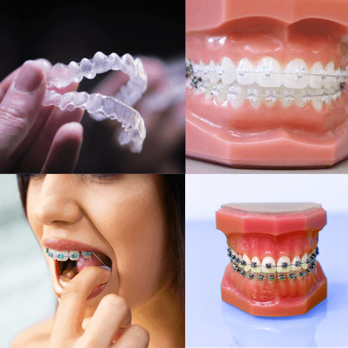 Image of different types of braces including damon braces, invisalign clear aligners, metal braces and six month smile