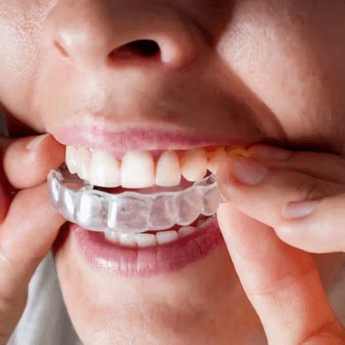 problems invisalign can fix. Stockport, manchester, Orthodontic centre