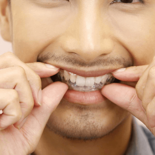 man putting in invisalign aligners, stockport, manchester