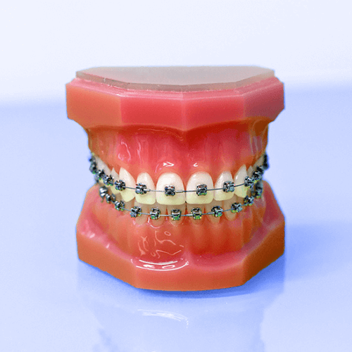 damon braces on a dental model