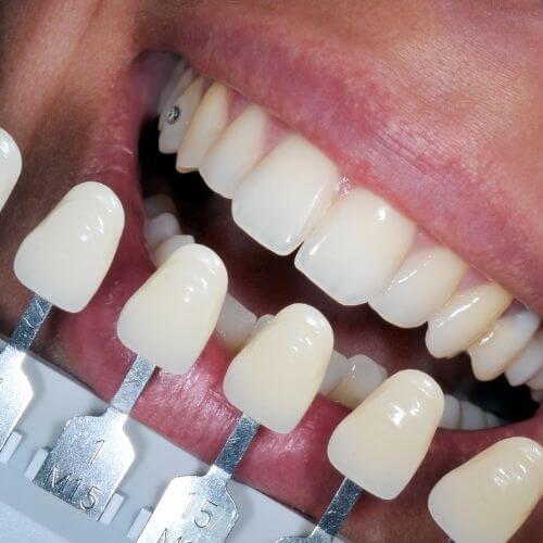 Can I Have Teeth Whitening After Invisalign (Manchester)