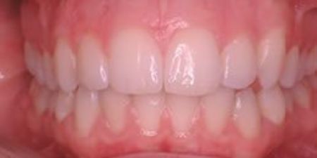 After Clear Aligners Treatment at Heaton Mersey Orthodontics in Stockport