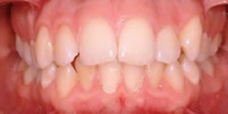 Before Clear Aligners Treatment at Heaton Mersey Orthodontics in Stockport