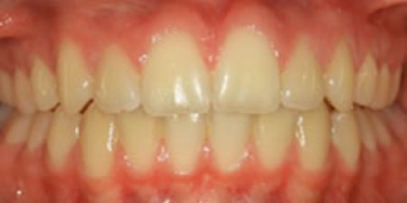 After self-ligating Braces Treatment at Heaton Mersey Orthodontics in Stockport, Manchester