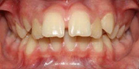 Before self-ligating Braces Treatment at Heaton Mersey Orthodontics in Stockport, Manchester