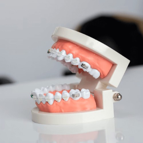 What You Need To Know About Damon Braces (Invisalign Manchester)