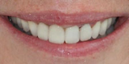 smile makeover results at heaton mersey orthodontic centre