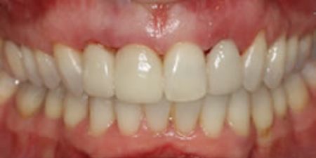 smile makeover treatment at heaton mersey orthodontic centre