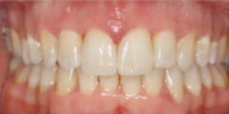 smile makeover treatment at heaton mersey orthodontic centre