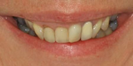 smile makeover treatment at heaton mersey orthodontic centre