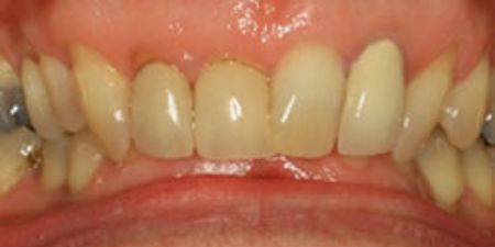 smile makeover treatment at heaton mersey orthodontic centre