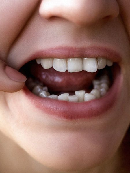 Childs teeth that are crowded.