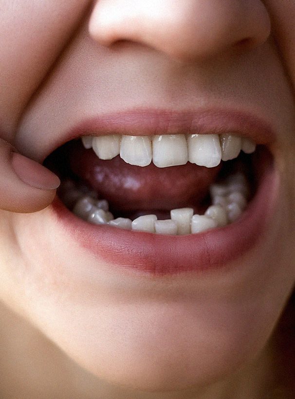 Childs teeth that are crowded.