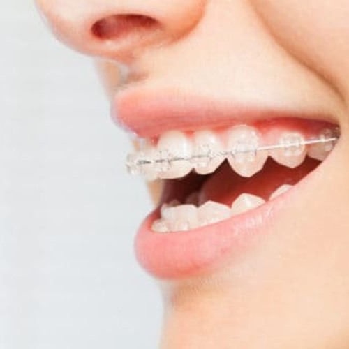 woman smiling with Six Month Smiles brace on her teeth