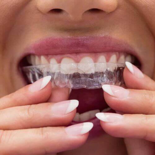 How Long Does Invisalign Take Heaton Mersey Orthodontics