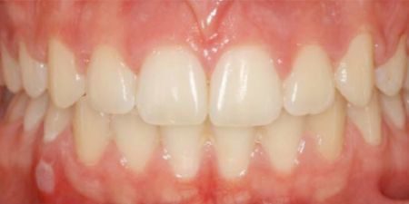 smile makeover treatment at heaton mersey orthodontic centre