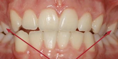 smile makeover treatment at heaton mersey orthodontic centre