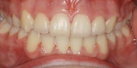 smile makeover treatment at heaton mersey orthodontic centre