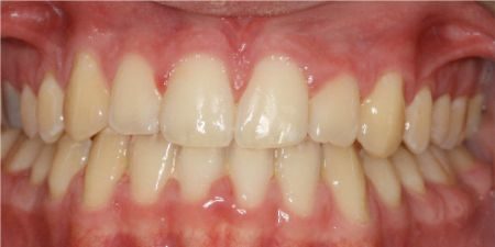 smile makeover treatment at heaton mersey orthodontic centre