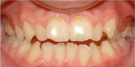 smile makeover treatment at heaton mersey orthodontic centre