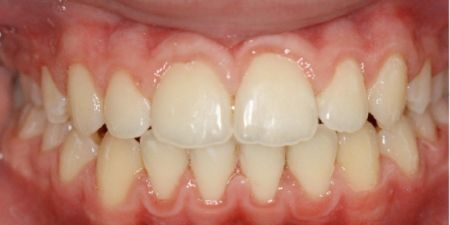 smile makeover treatment at heaton mersey orthodontic centre