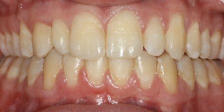 smile makeover treatment at heaton mersey orthodontic centre