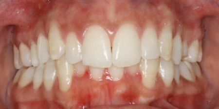 smile makeover treatment at heaton mersey orthodontic centre