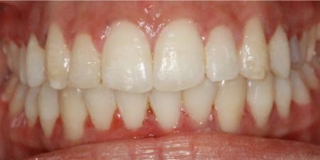 smile makeover treatment at heaton mersey orthodontic centre