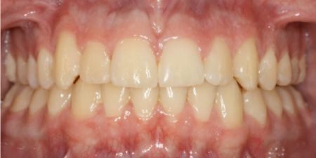 smile makeover treatment at heaton mersey orthodontic centre