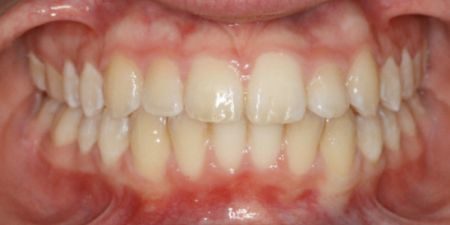 smile makeover treatment at heaton mersey orthodontic centre