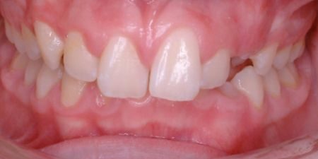 smile makeover treatment at heaton mersey orthodontic centre before image