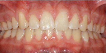 smile makeover treatment at heaton mersey orthodontic centre
