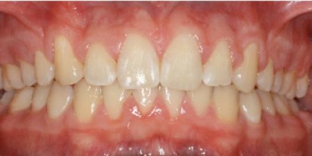 smile makeover treatment at heaton mersey orthodontic centre after image