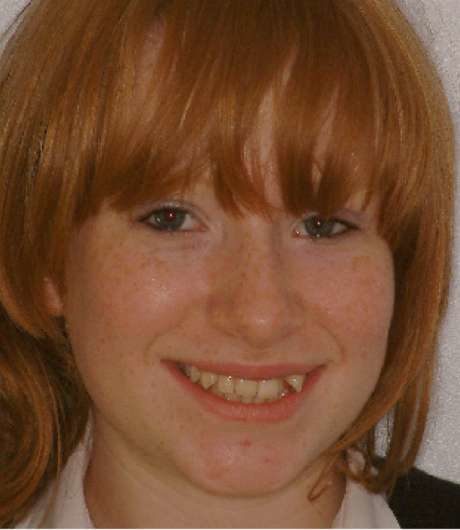 Teeth before NHS braces before image