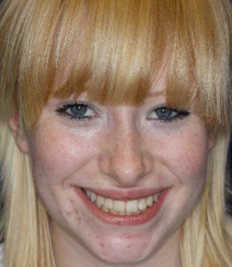 Teeth after NHS braces after