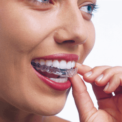woman putting in invisalign aligners