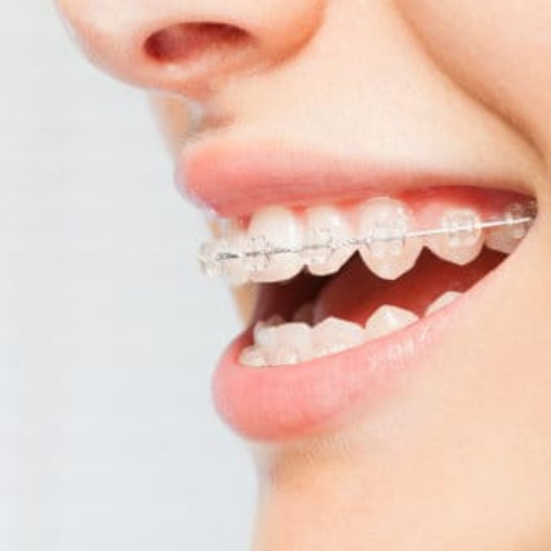 woman smiling with Six Month Smiles braces