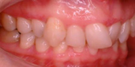 andrea's treatment at Heaton Mersey Orthodontic Centre